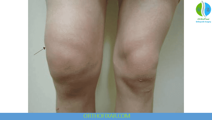 Joint Effusion