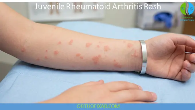 Juvenile Rheumatoid Arthritis Rash