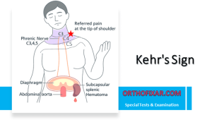 Kehr’s Sign