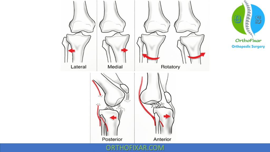 Kennedy classification for Knee Dislocation