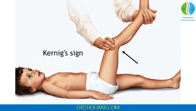 Kernig Sign & Brudzinski Sign 2 Kernig Sign