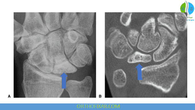 Kienböck disease