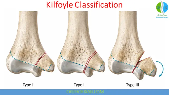 Pediatric Medial Humeral Condyle Fractures 7 Kilfoyle Classification