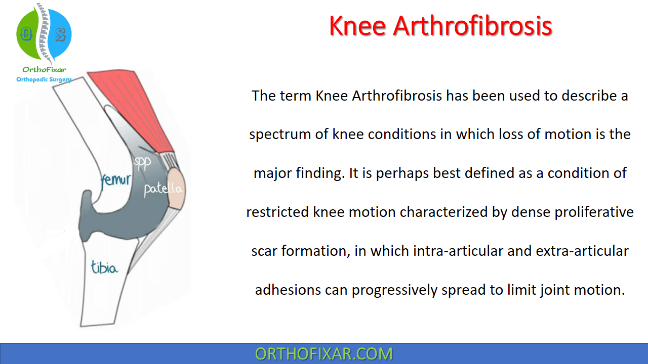 Knee Arthrofibrosis