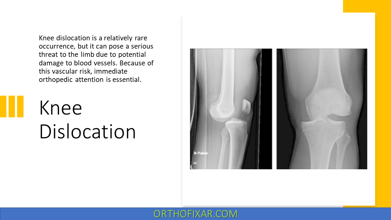 Knee Dislocation | Diagnosis & Treatment 