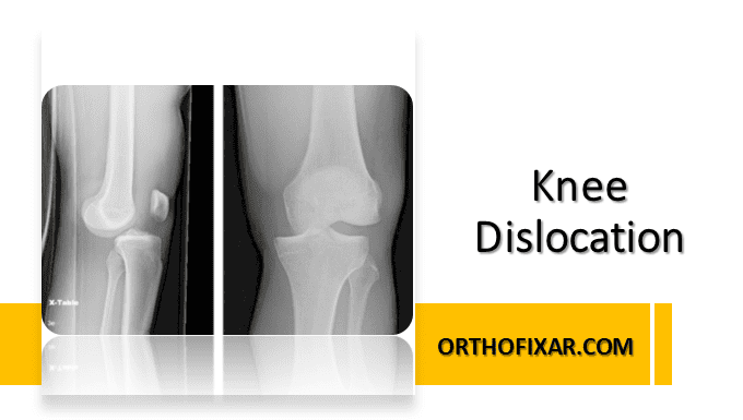 knee dislocation x ray