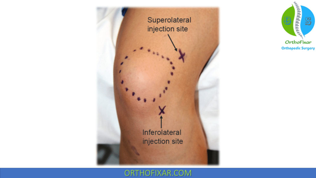 Knee Injection Technique Inferolateral Approach