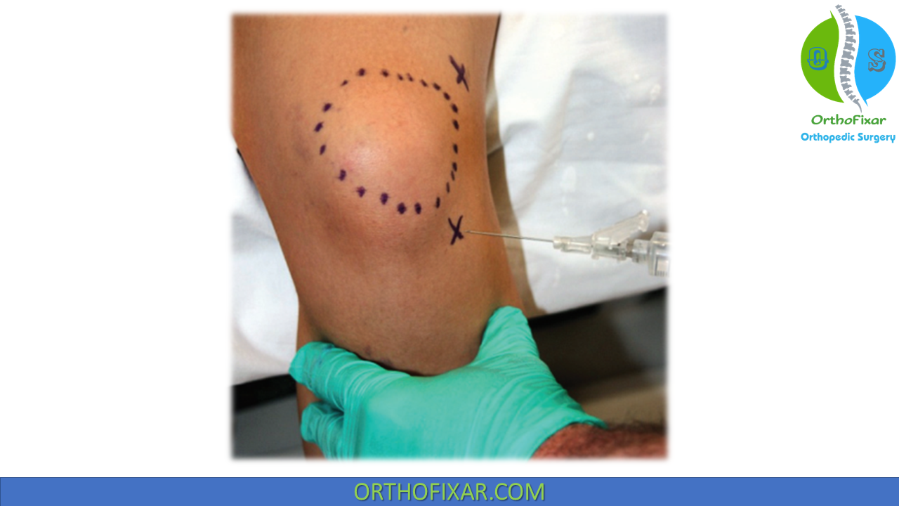 Knee Injection Technique: Superolateral Approach Step-by-Step Guide