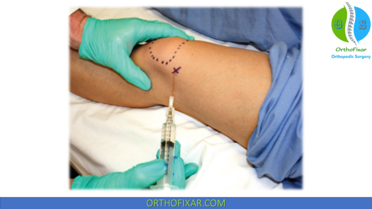 Knee Injection Technique: Superolateral Approach Step-by-Step Guide