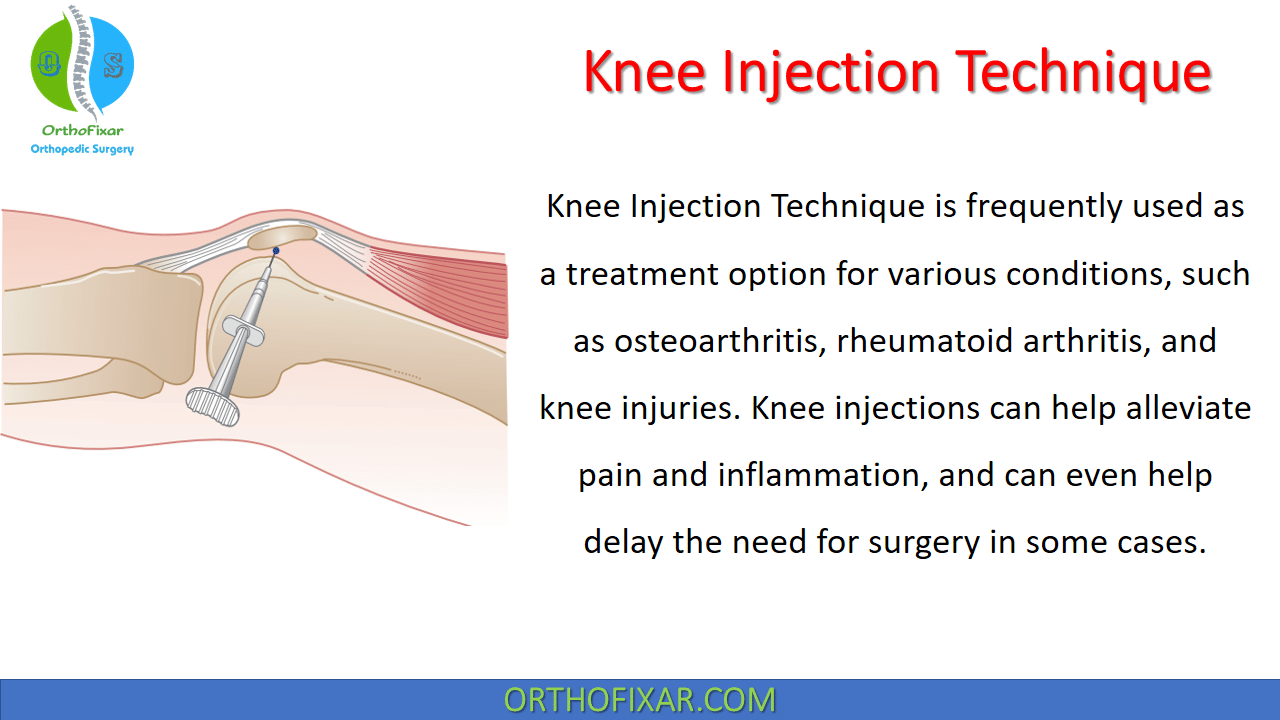Knee Injection Technique