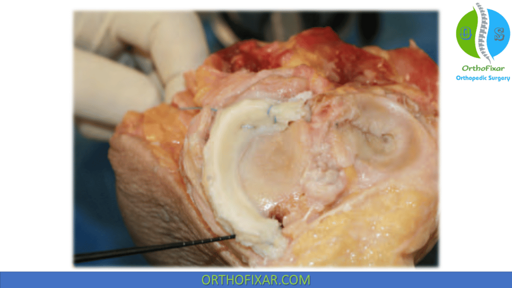 Knee Meniscal Transplantation (1)