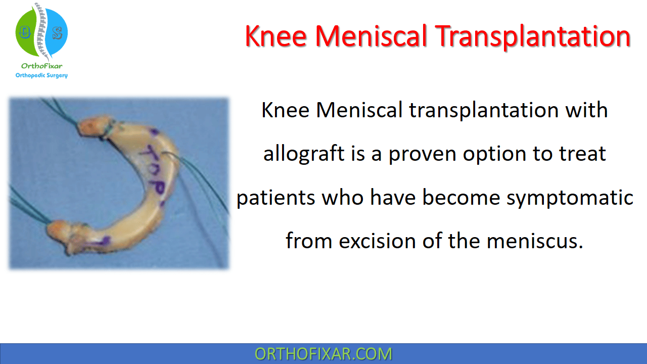  Knee Meniscal Transplantation 