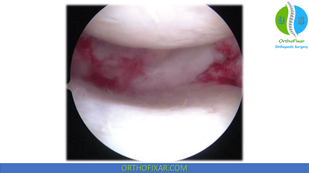 Knee Meniscal Transplantation (3)