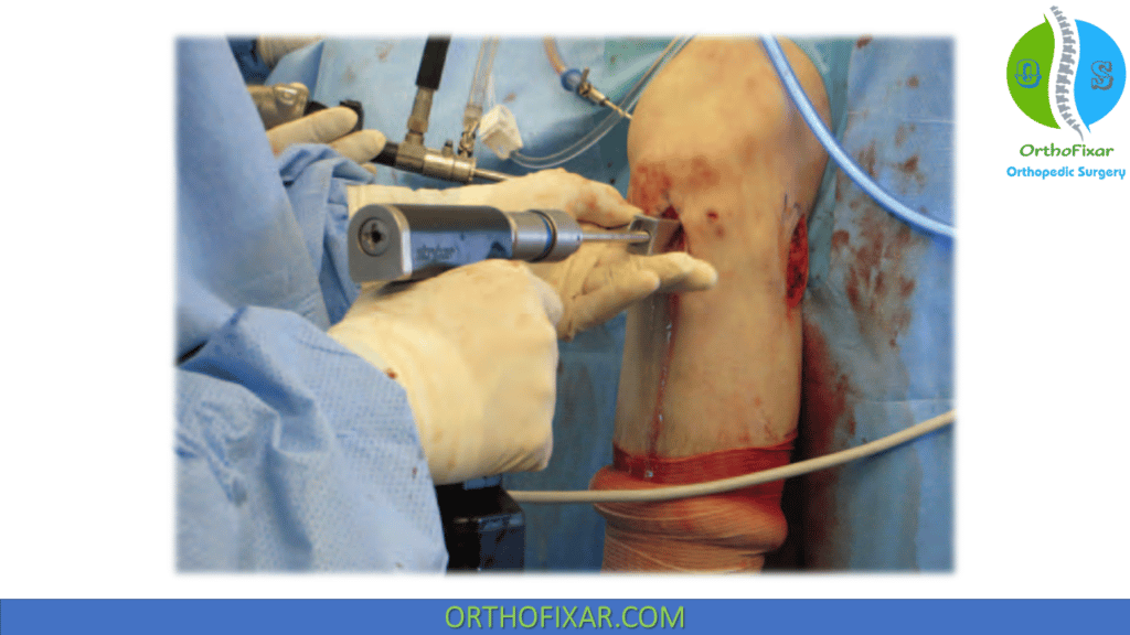 Knee Meniscal Transplantation (4)