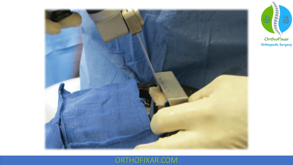 Knee Meniscal Transplantation (7)