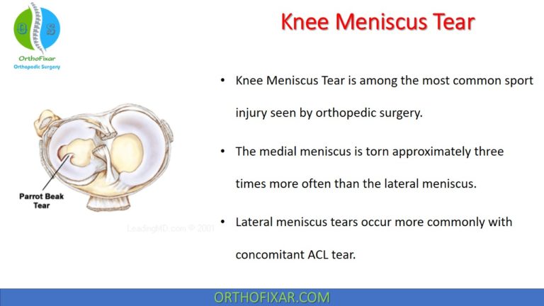 Knee Meniscus Tear