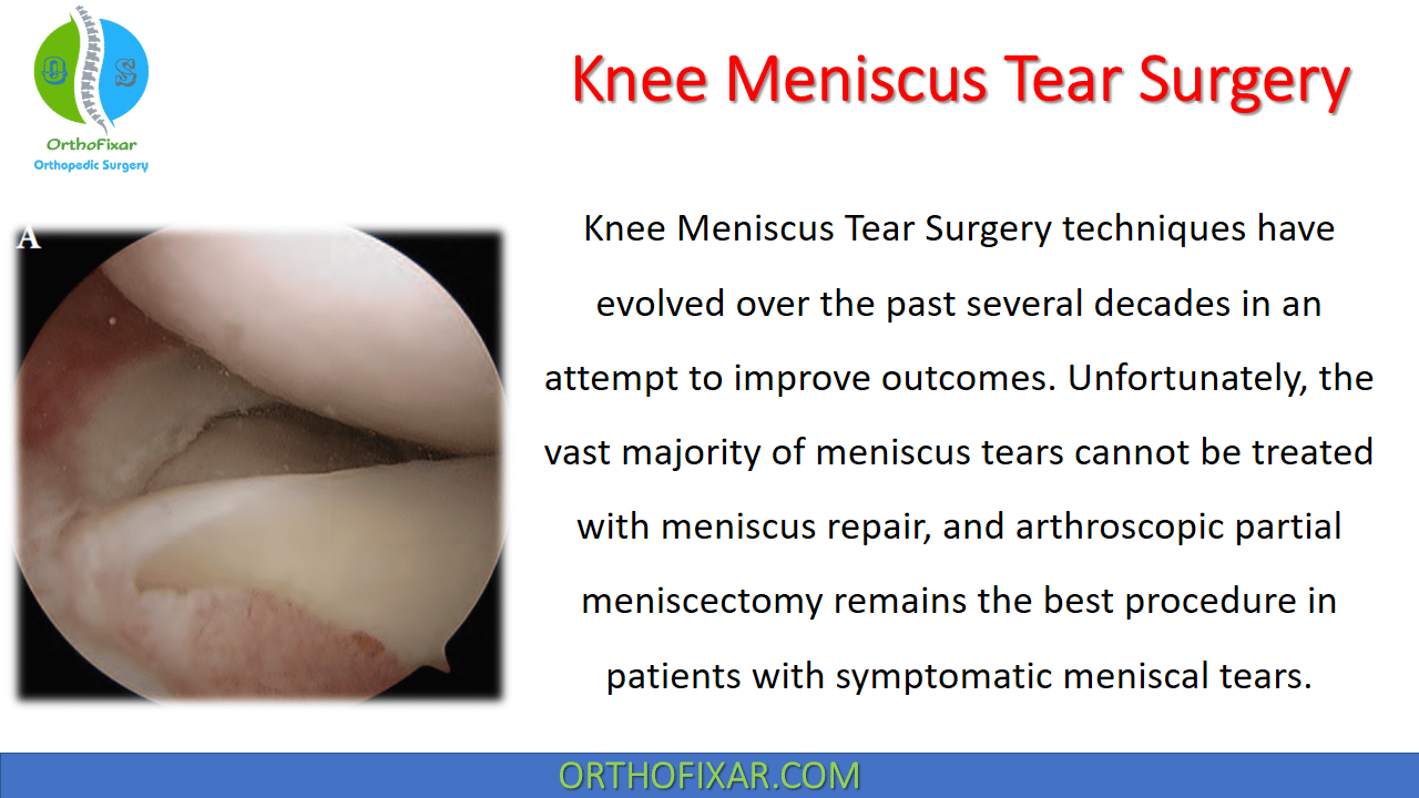 Knee Meniscus Tear Surgery