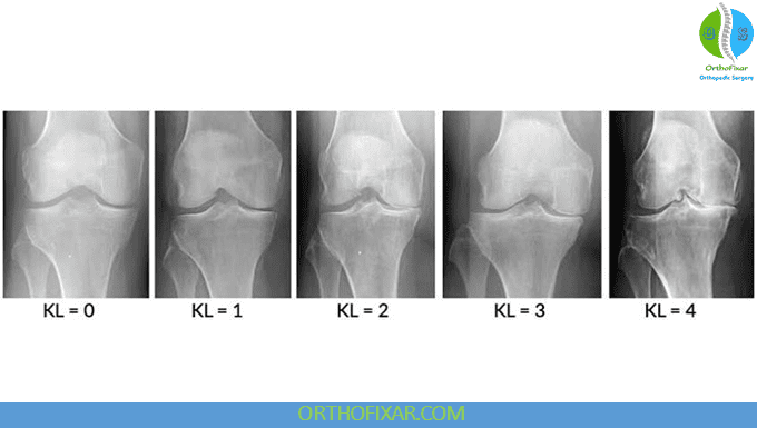 Knee Osteoarthritis Stages