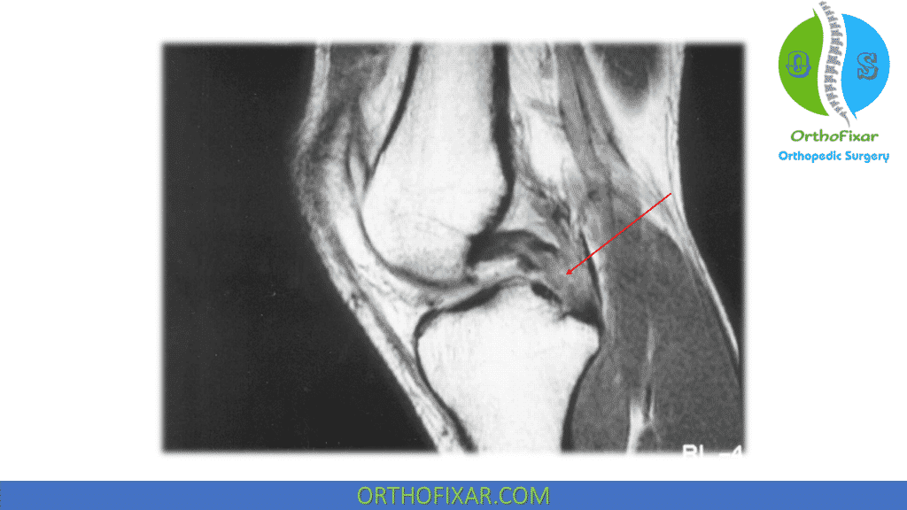 Knee PCL Injury mri