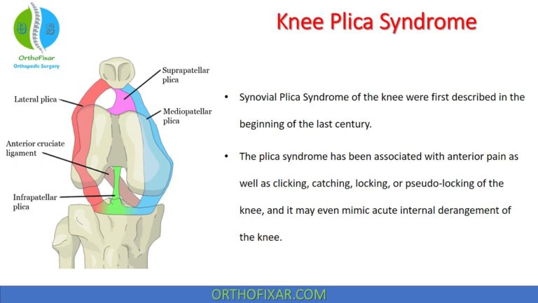 Knee Plica Syndrome
