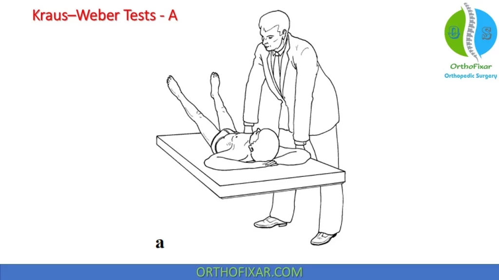 Kraus Weber Tests - A