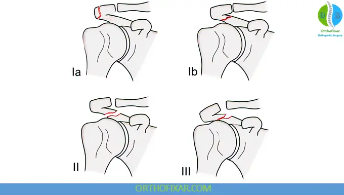 Acromial Fractures: Diagnosis, Classification & Treatment 7 Kuhn Classification Acromial Fractures