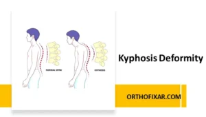Kyphosis Deformity