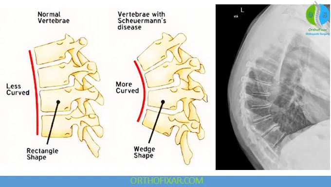 Kyphosis - Scheuermann’s Disease