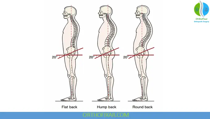 Kyphosis types