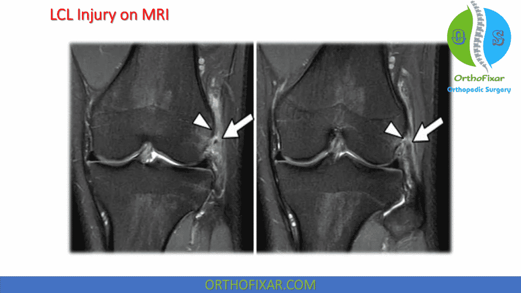 Knee LCL Sprain | OrthoFixar 2024