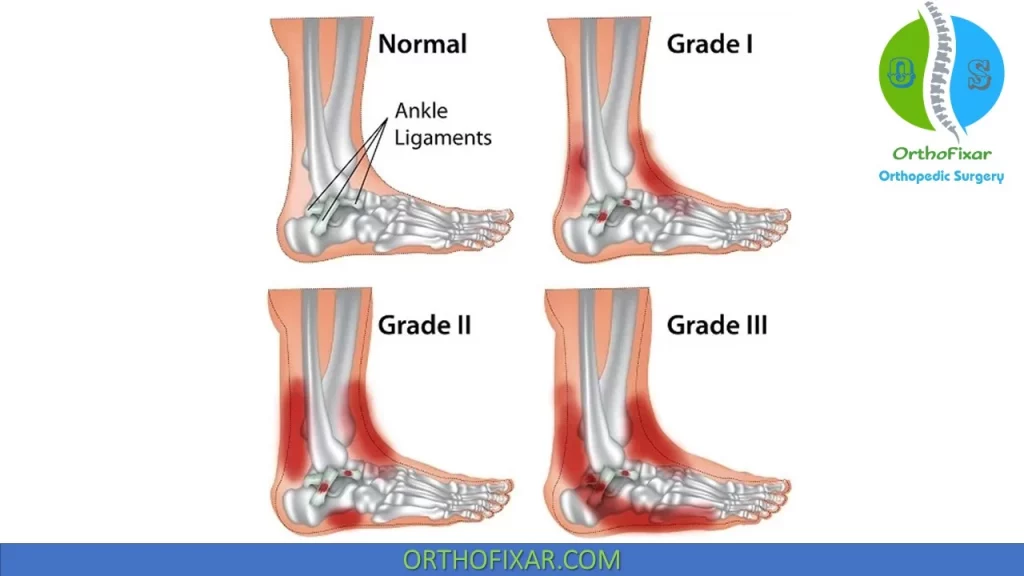 Lateral Ankle Sprain Grades