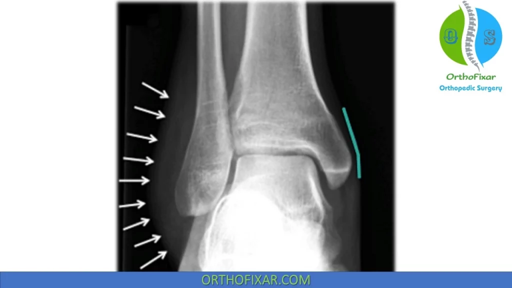Lateral Ankle Sprain imaging