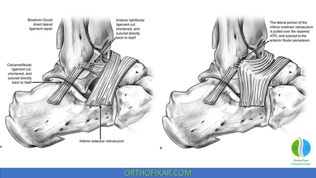 Lateral Ankle Sprain treatment - Modified Bröstrom procedure