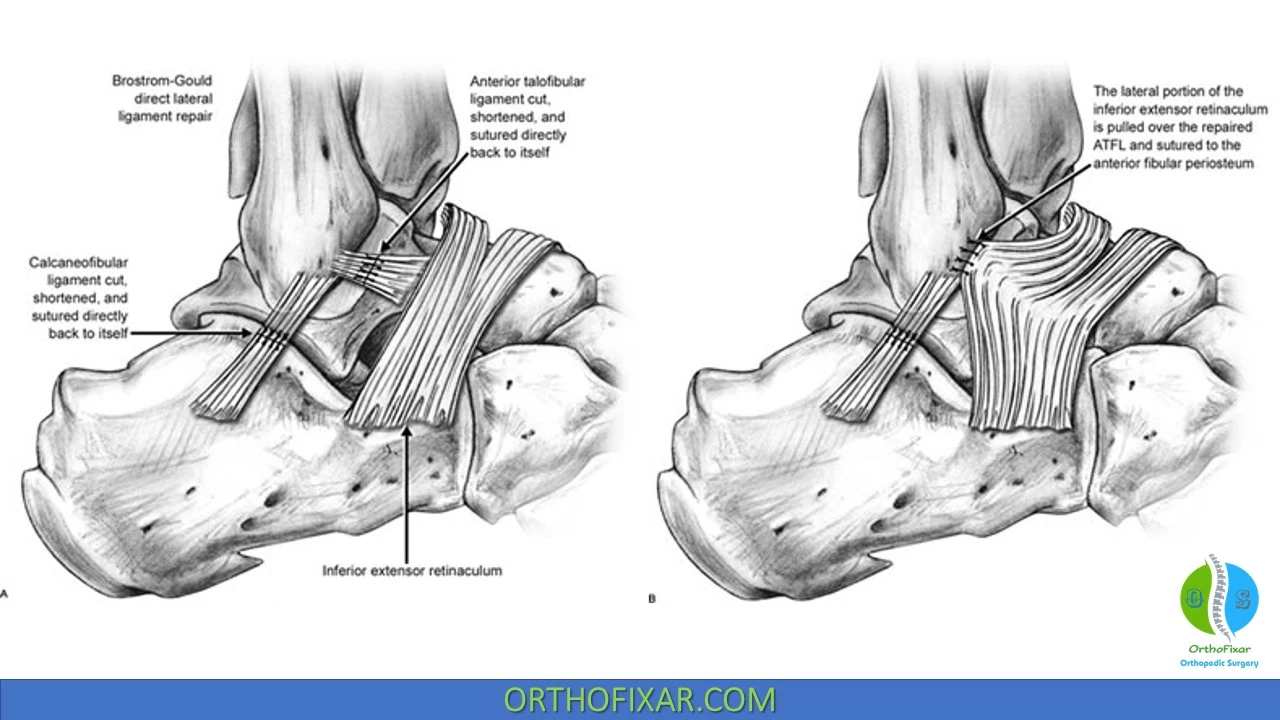 Talar Tilt Test  OrthoFixar 2023