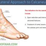 Lateral Approach To Calcaneus - OrthoFixar 2021