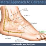 Lateral Approach To Calcaneus - OrthoFixar 2021