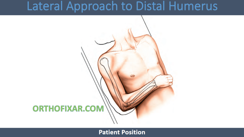 Lateral Approach to Distal Humerus