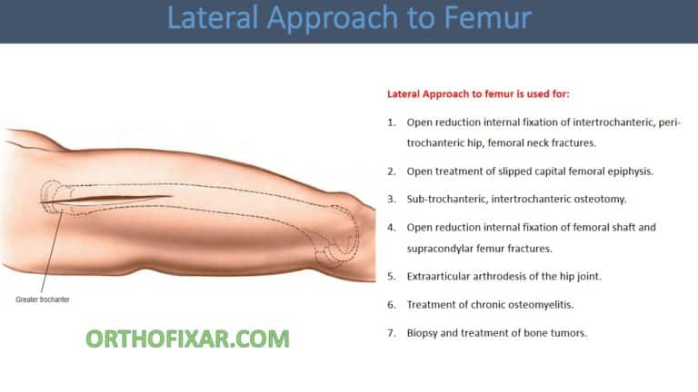 Lateral Approach to Femur