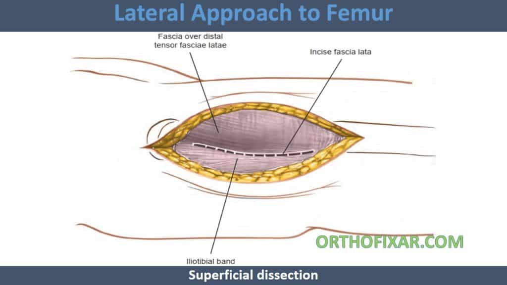 Lateral Approach to Femur