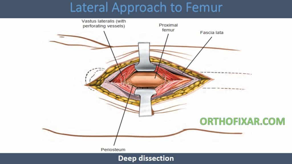 Lateral Approach to Femur