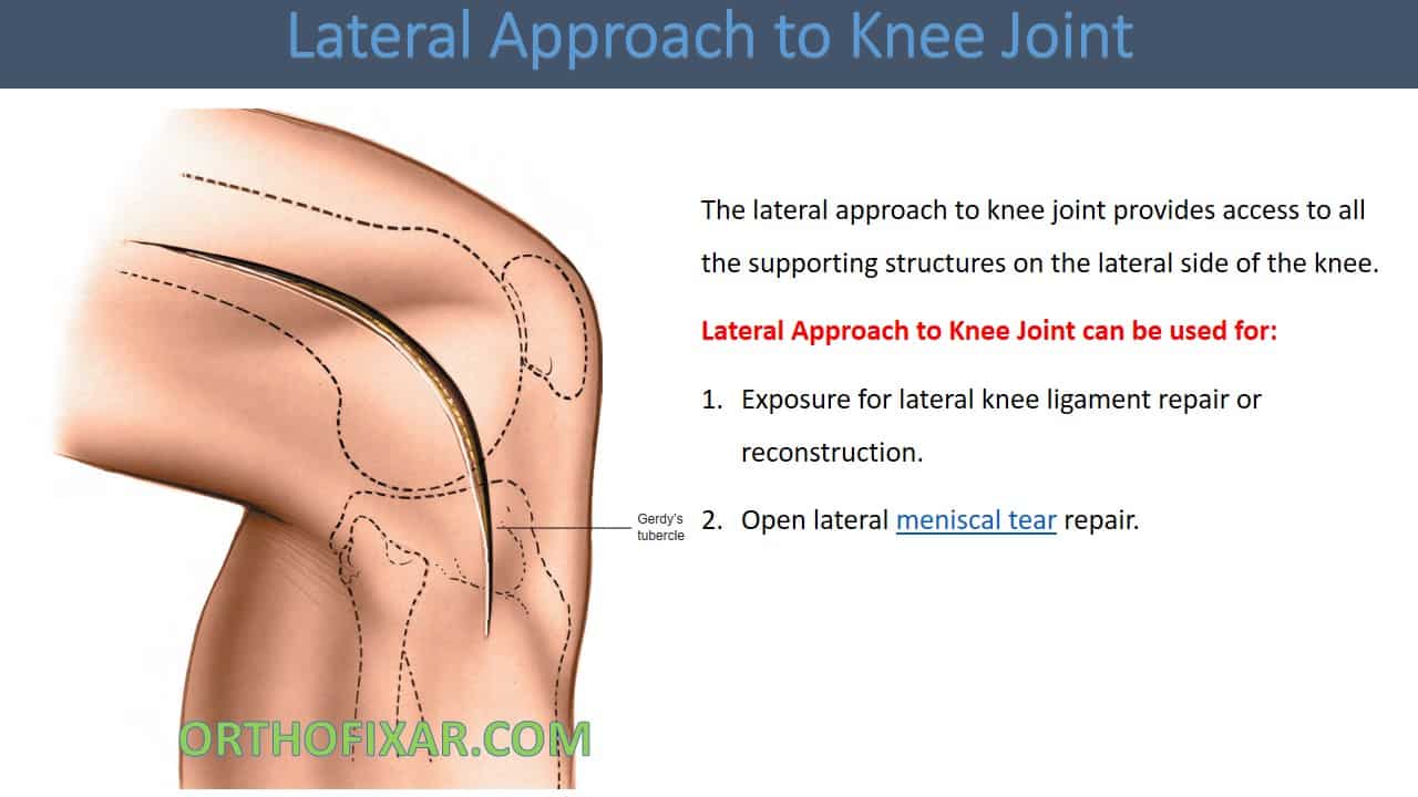  Lateral Approach to Knee Joint 