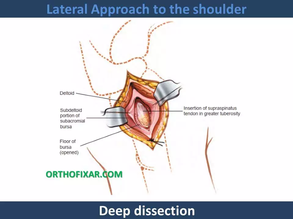 Lateral Approach to the shoulder 