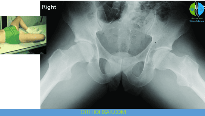 Hip Joint X-Ray Imaging 7 Lateral (Axial “Frog-Leg”) View