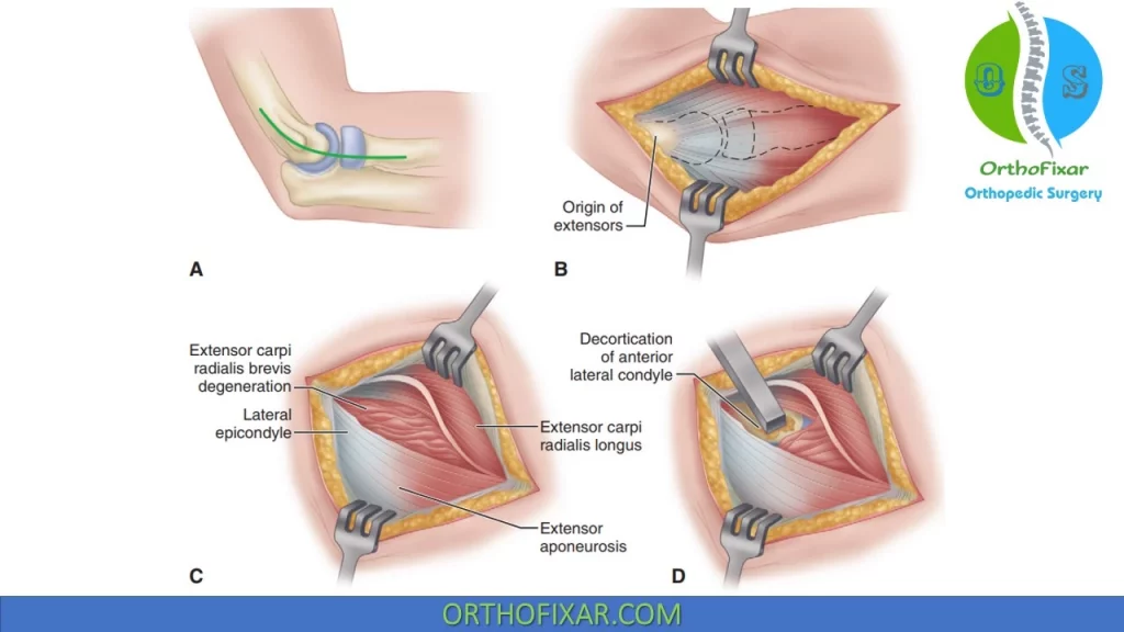Lateral Epicondylitis Surgery Procedure