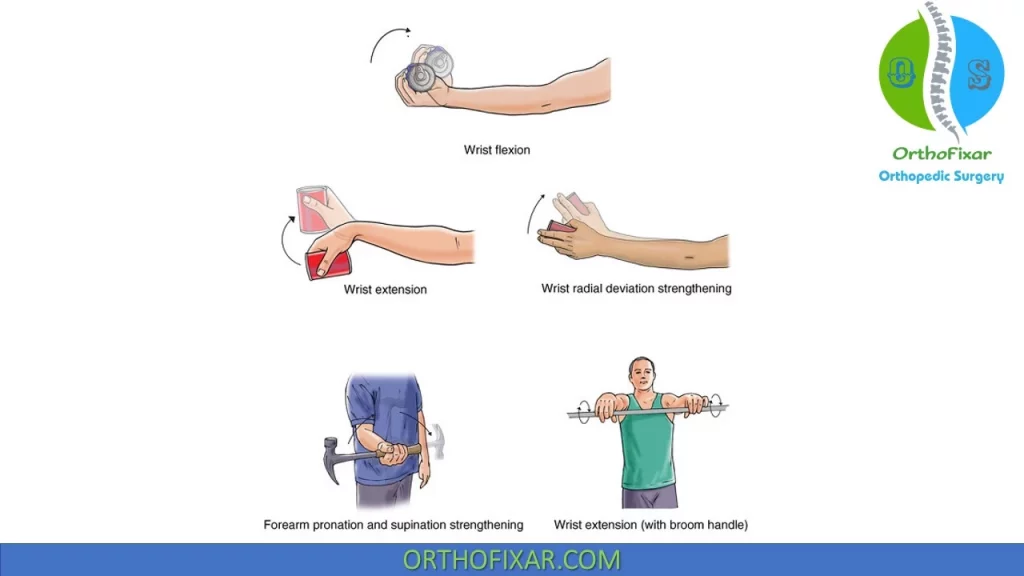 Lateral Epicondylitis | OrthoFixar 2023