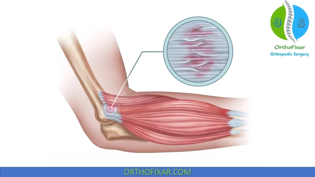 Lateral Epicondylitis - tennis elbow