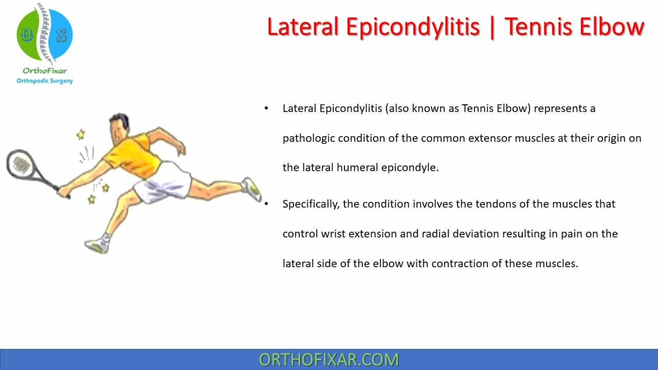  Lateral Epicondylitis 
