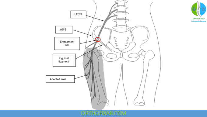 Lateral Femoral Cutaneous Nerve Anatomy 2 Lateral Femoral Cutaneous Nerve compression
