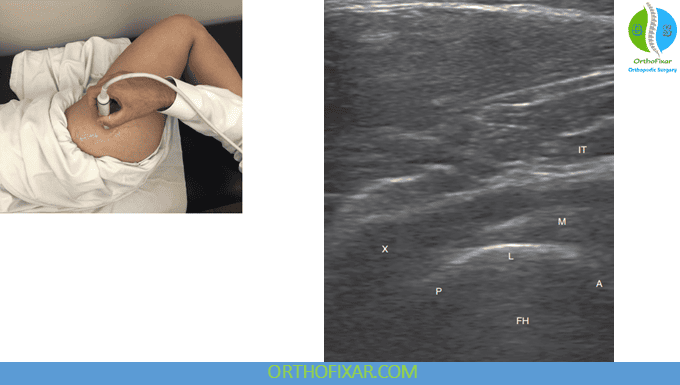 Lateral Hip Ultrasound