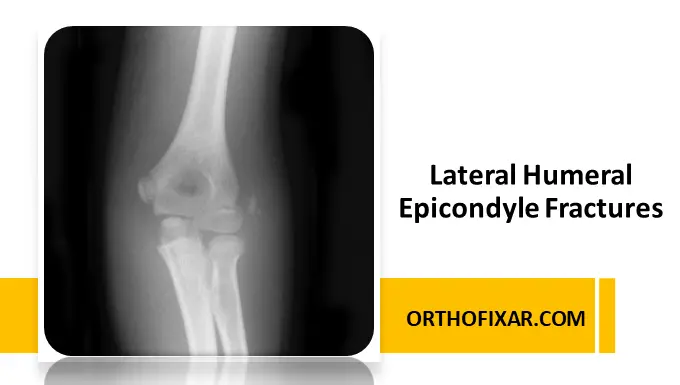 Lateral Humeral Epicondyle Fractures